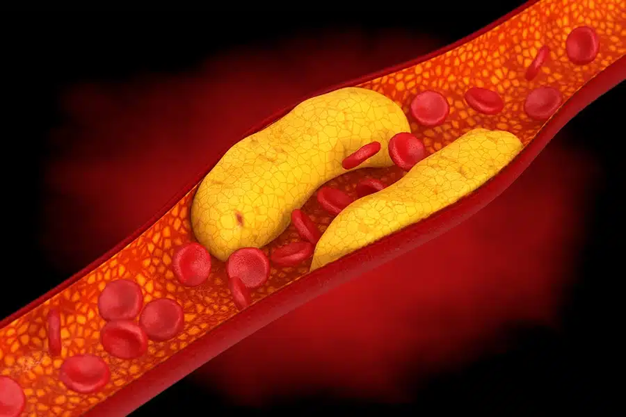 Illustration of artery with plaque buildup due to high cholesterol.