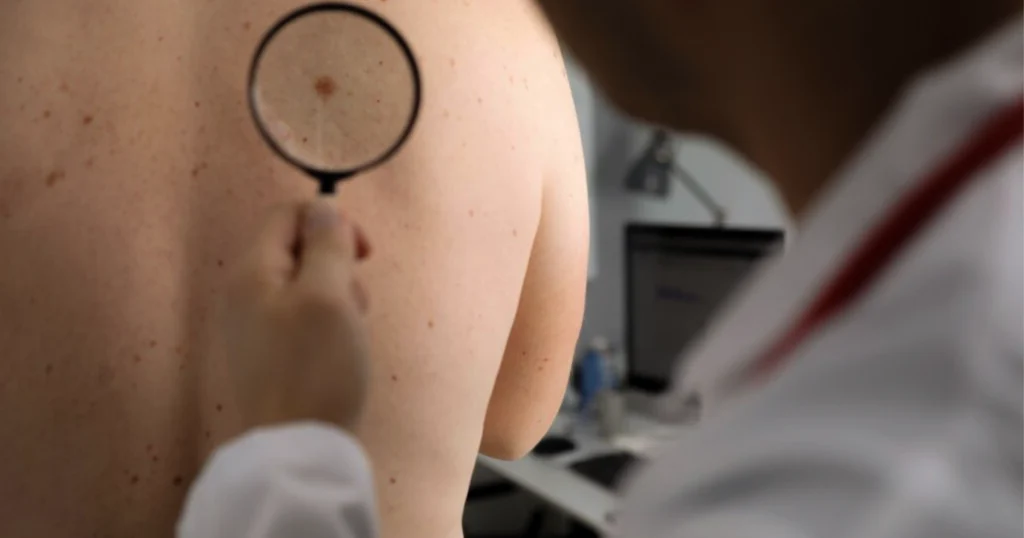 Doctor closely examining a skin lesion on a patient’s back