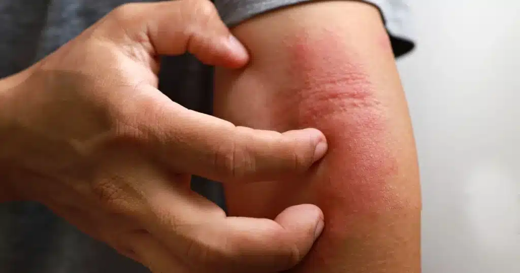 Close-up of a person scratching red, irritated skin on their arm.