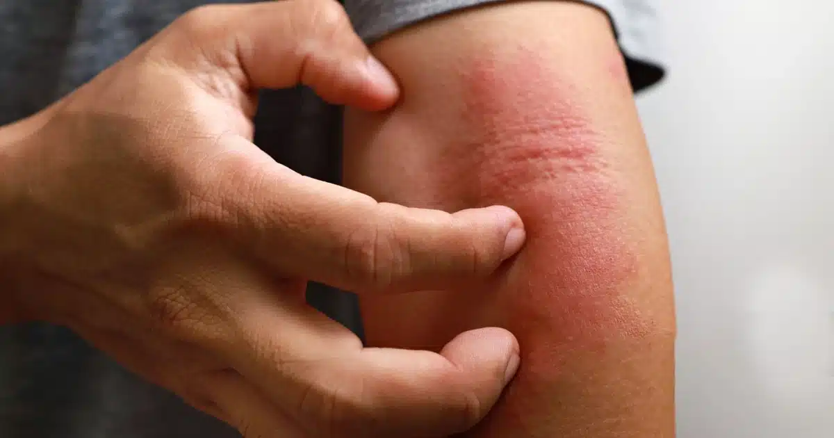 Can Skin Irritation Cause Acne