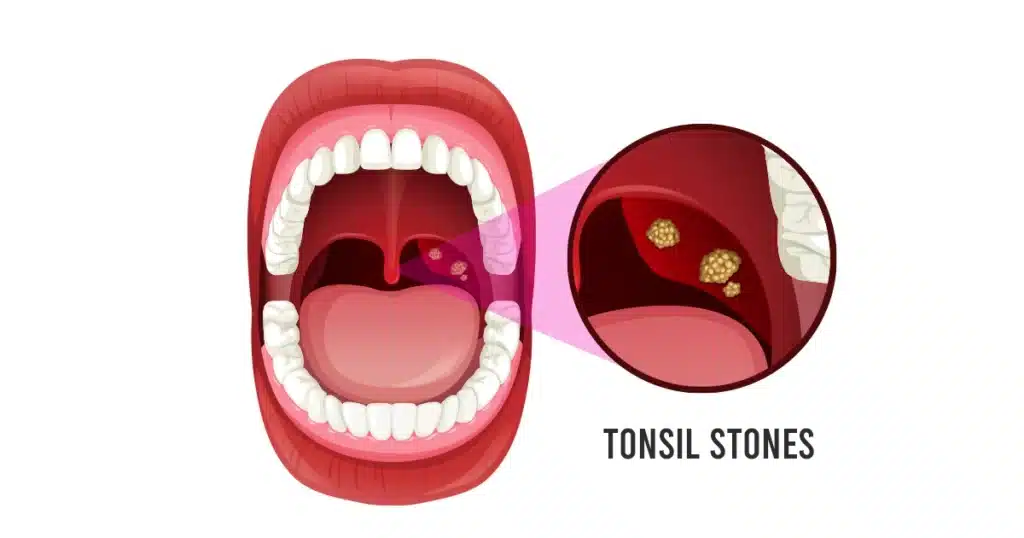 Tonsil stones visible inside the throat illustration.