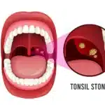 Tonsil stones visible inside the throat illustration.