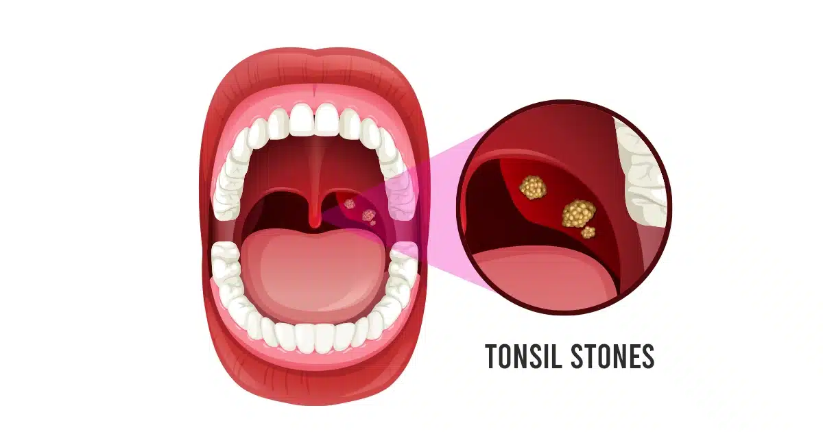 What Causes Tonsil Stones