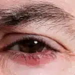 Close-up of irritated itchy eye with redness.