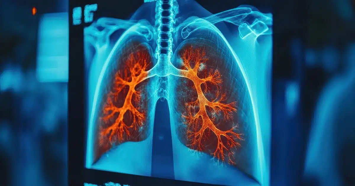 Is Pneumonia Contagious