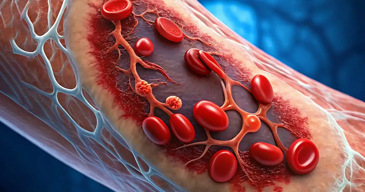 What Causes Blood Clots