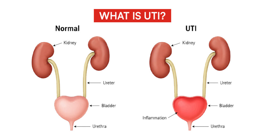 Nauseous woman holding stomach from a UTI.