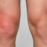 Swollen knee showing knee fluid buildup.