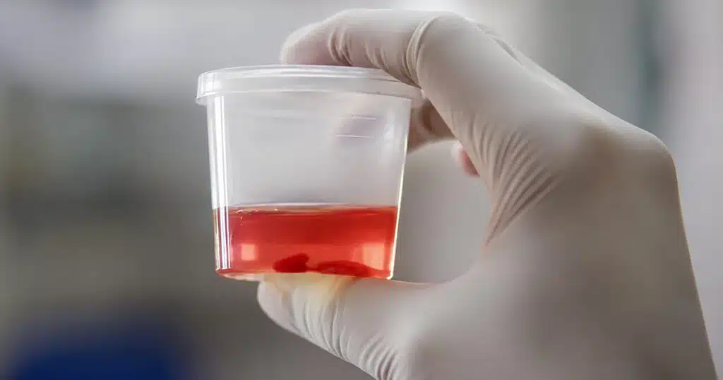 Gloved hand holding a urine sample cup with urine and a visible blood clot