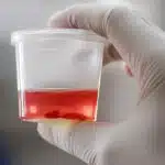 Gloved hand holding a urine sample cup with urine and a visible blood clot