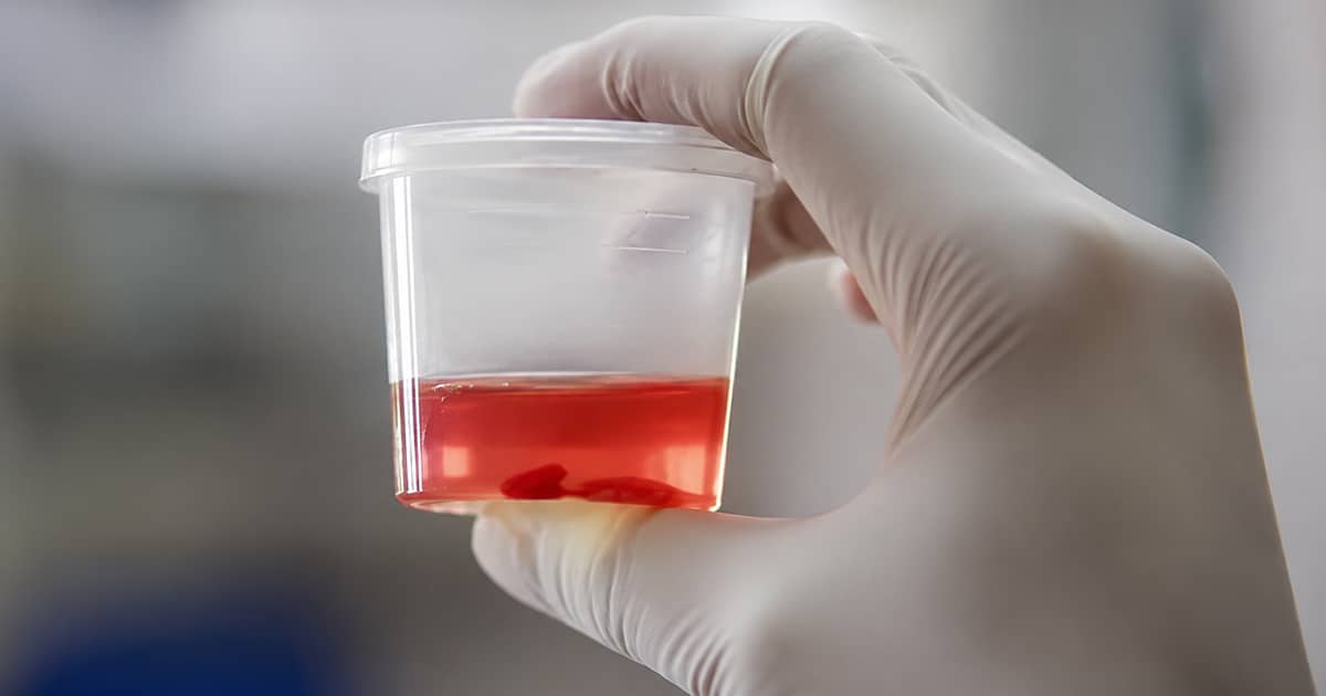 Blood Clots in Urine (Hematuria)