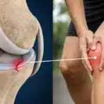 Illustration of a torn knee meniscus beside a person holding a painful knee.