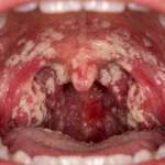 Oral yeast infection from candida overgrowth.