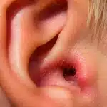 Close-up of a red, inflamed ear canal caused by swimmer’s ear.