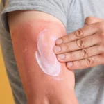 Close-up of a man applying soothing white lotion to a severe red sunburn on his upper arm against a yellow background.