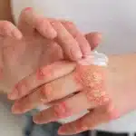 Person applying soothing ointment to inflamed, dry skin on hand.