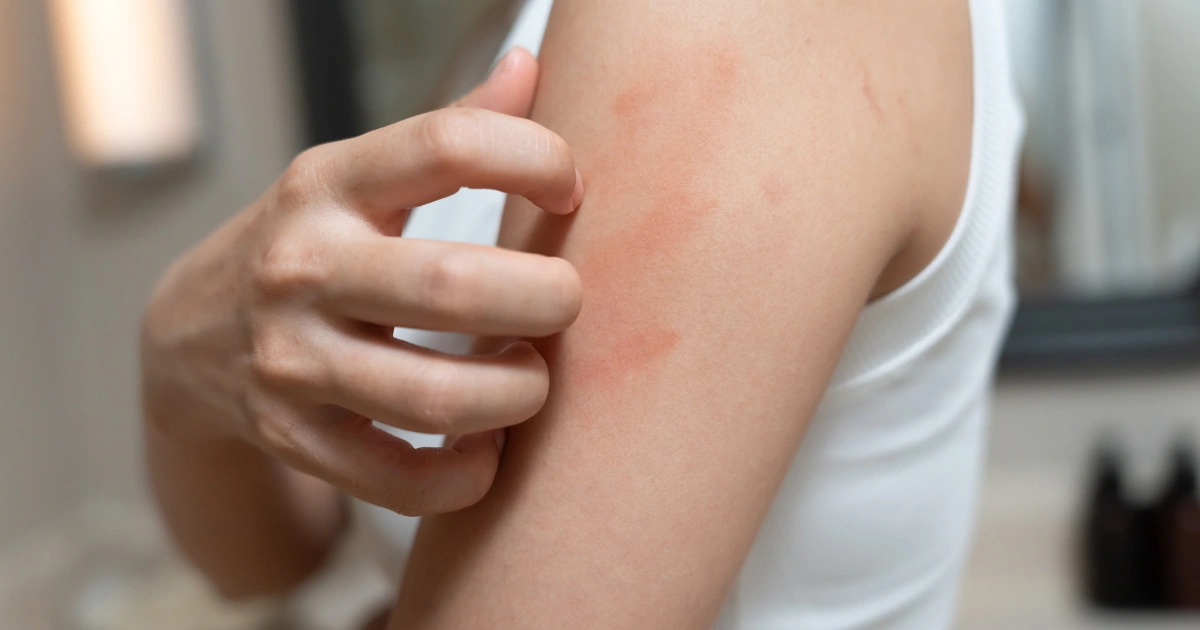 How Long Does an Allergic Reaction Last?