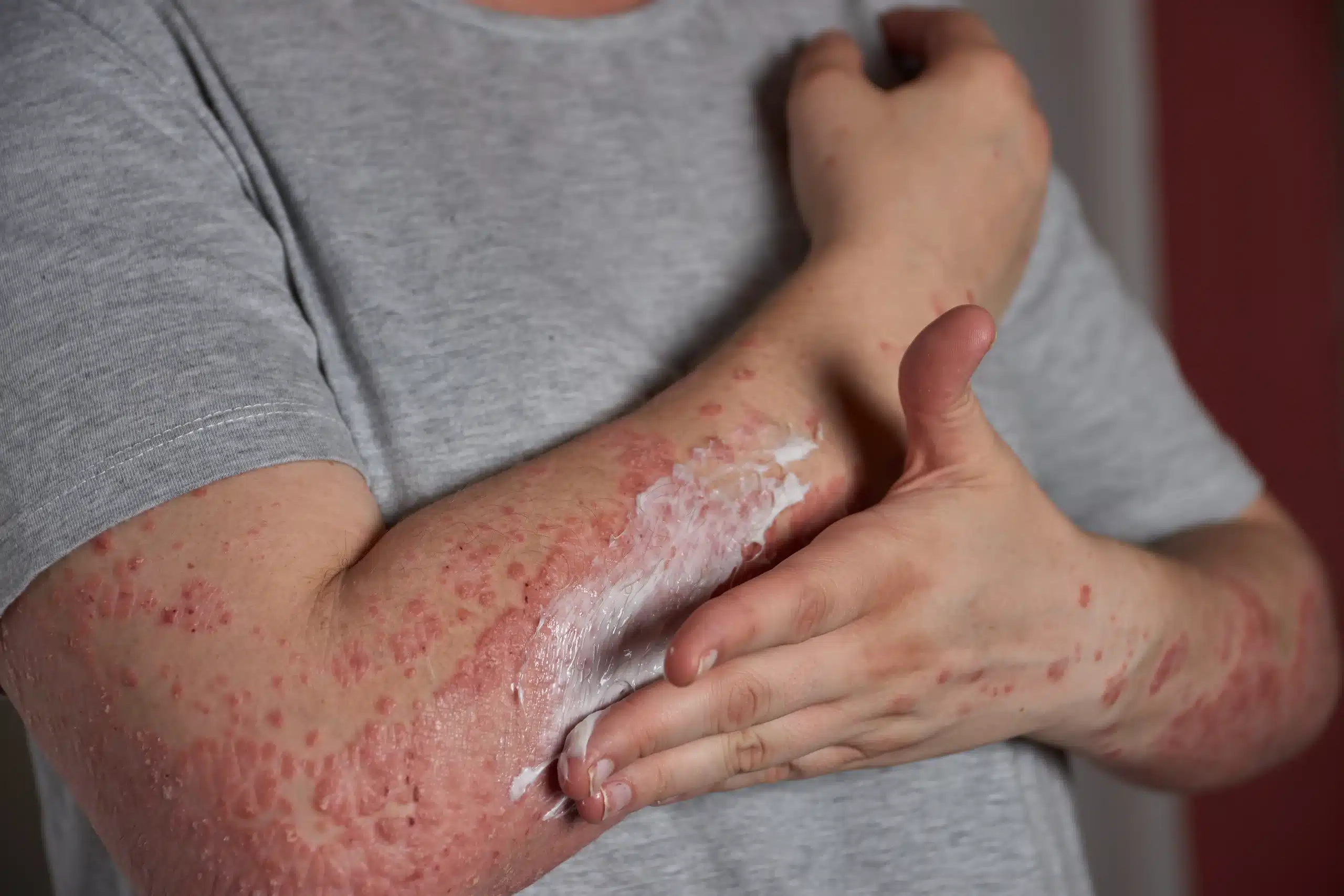 What Is Eczema?