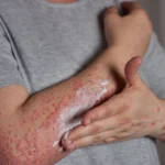 Close-up of a person applying cream to a red skin rash on their arm.